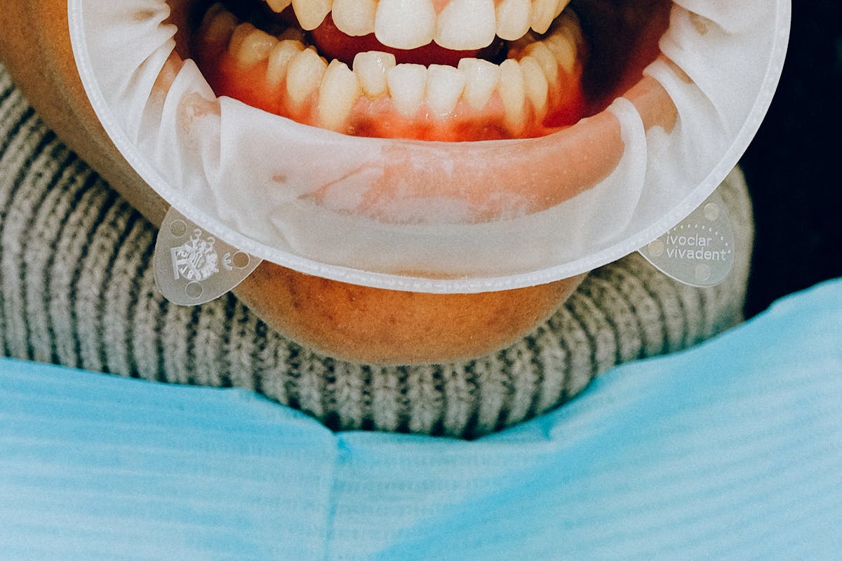 overcrowded teeth