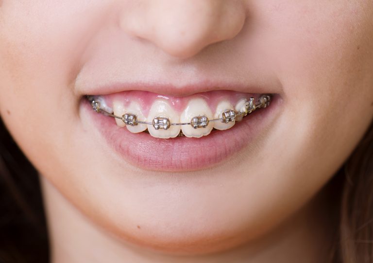 Metal vs. Ceramic Braces  Which is Better?