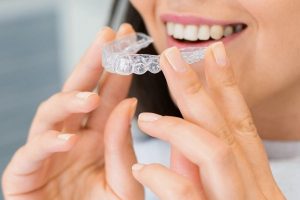 Invisalign aligners